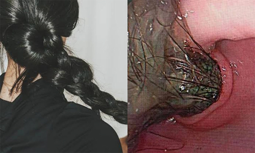 Mass hair removed